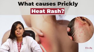 Reason Prickly Heat Rash| Summer Verkuru Treatment | Elixify | Tamil