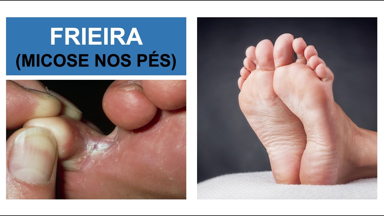 MICOSE NOS PÉS (Frieira) - Como combater? Por Luiz Gameiro, dermatologista