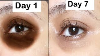 How to Remove Dark Circles Naturally Overnight (100% Results) || How to Get Rid of Dark Undereyes