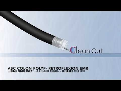 Colonoscopy: Retroflexion EMR in Ascending Colon Underwater