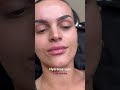 Guess how much dermal filler was used to achieve this? 👄👄👄 #fillers #fillerup#dermalfillers