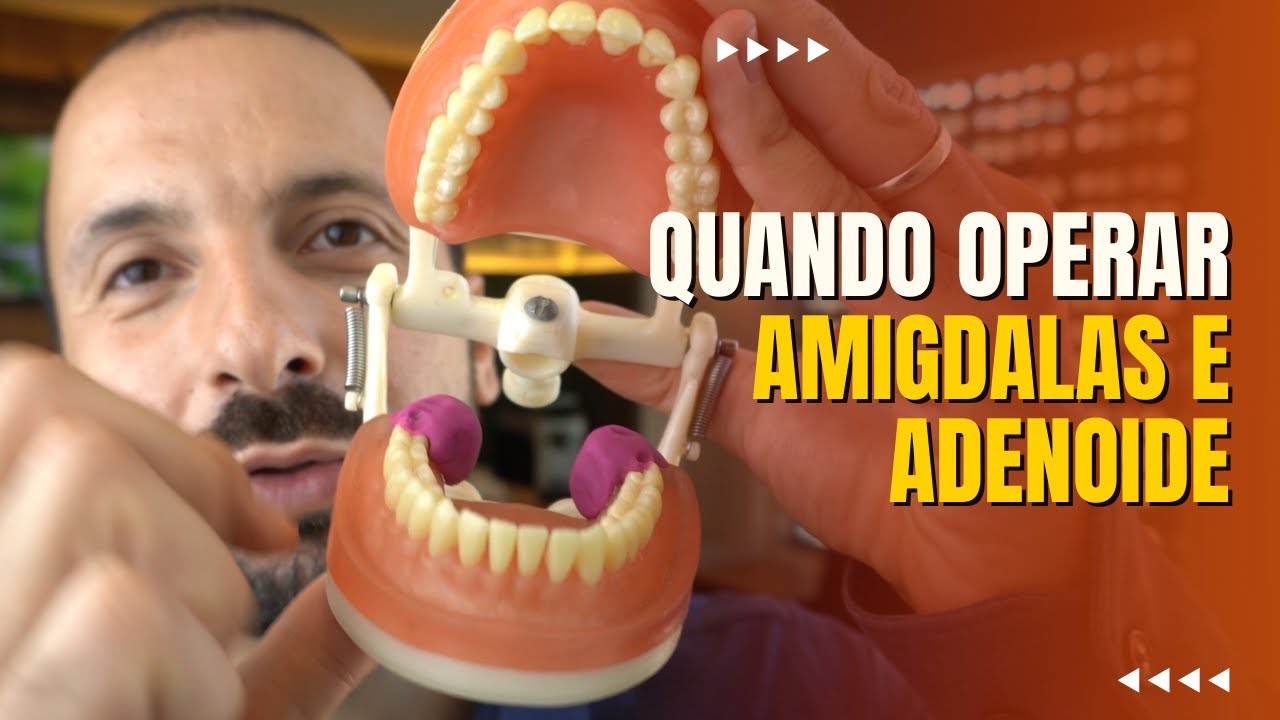 QUANDO OPERAR AMIGDALA E ADENOIDE?