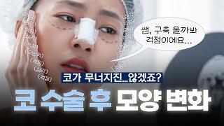 '코 수술 후 모양변화를 피하기 위해서는요...! (ft. 마인드성형외과 - 이강우 원장님)