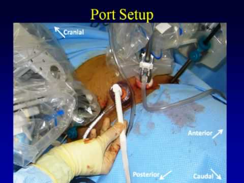 Crioablación renal retroperitoneal asistida por robot