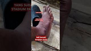 Download lagu asam urat parah,apa obatnya dan bagaimana cara obatinya?  apa harus operasi? #asamurat #purin mp3