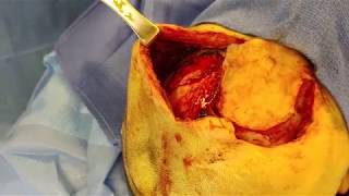 3D Skull (Calvarium) Reconstruction