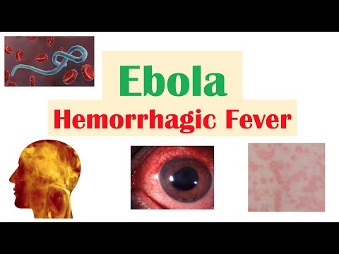 Schistosomiasis Bilharziasis Causes Symptoms and Treatment