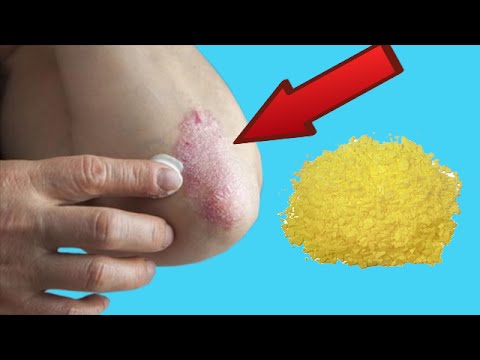 La psoriasis en el cuerpo después del parto Las grandes personas cerca de que eran la psoriasis