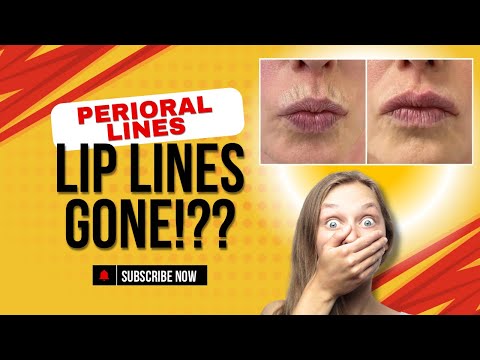 Perioral Lines
