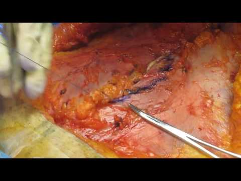 Dr. Wiener abdominoplasty muscle tightening