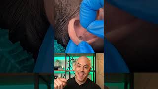 Derm reacts to a very hairy ear-piercing removal! #dermreacts #doctorreacts #earpiercing