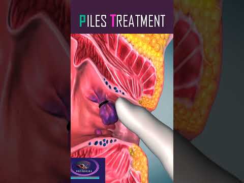 Piles Treatment #shorts #piles