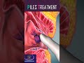 Piles Treatment Shorts Piles