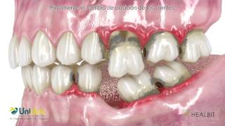 La prótesis dental removible