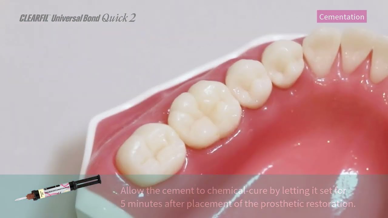 5. Cementation of Indirect Restorations
