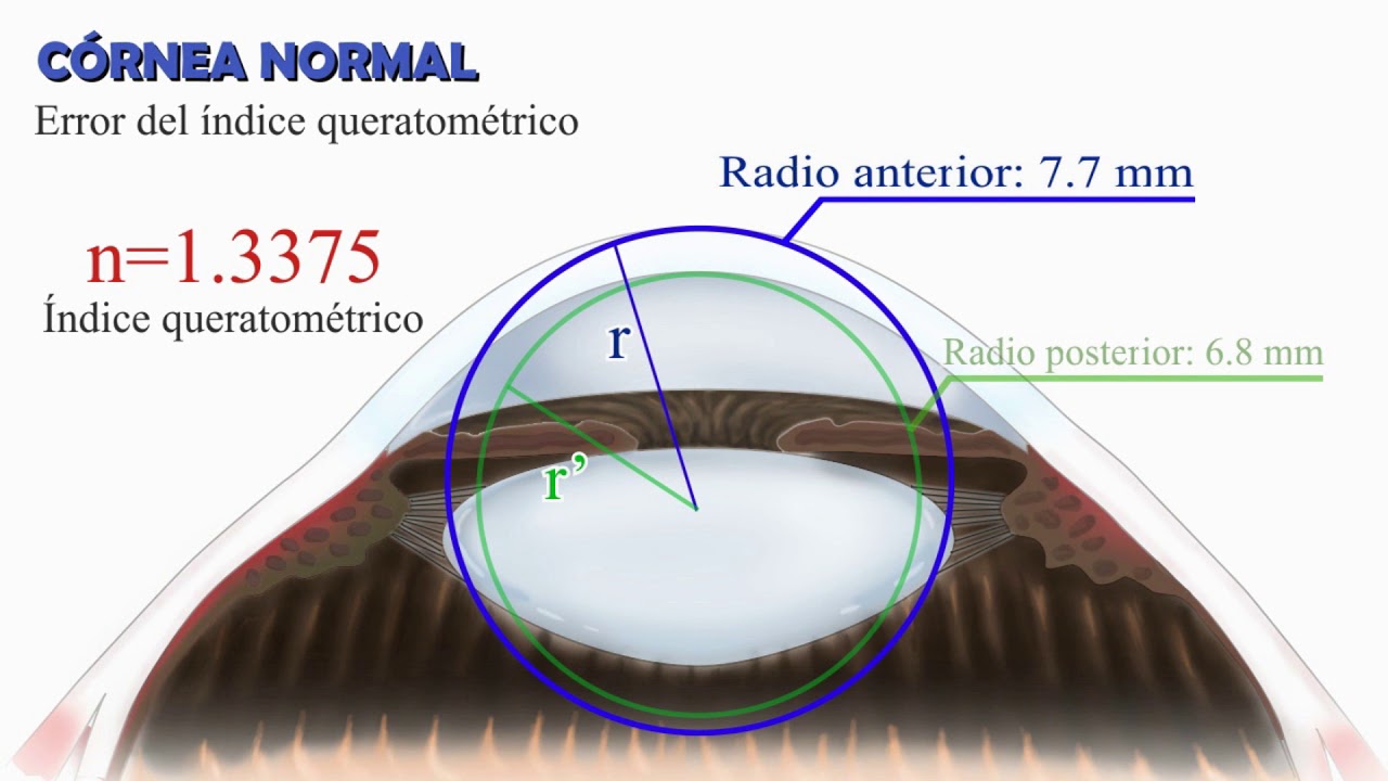 Cálculo del poder del lente intraocular luego de cirugía refractiva (biometría post-excimer láser)