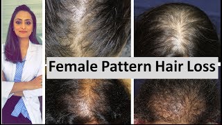 Hair loss in women | Female Pattern Hair Loss | causes & treatment | Dermatologist