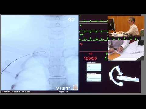 Catheterisation of Left Coronary Artery