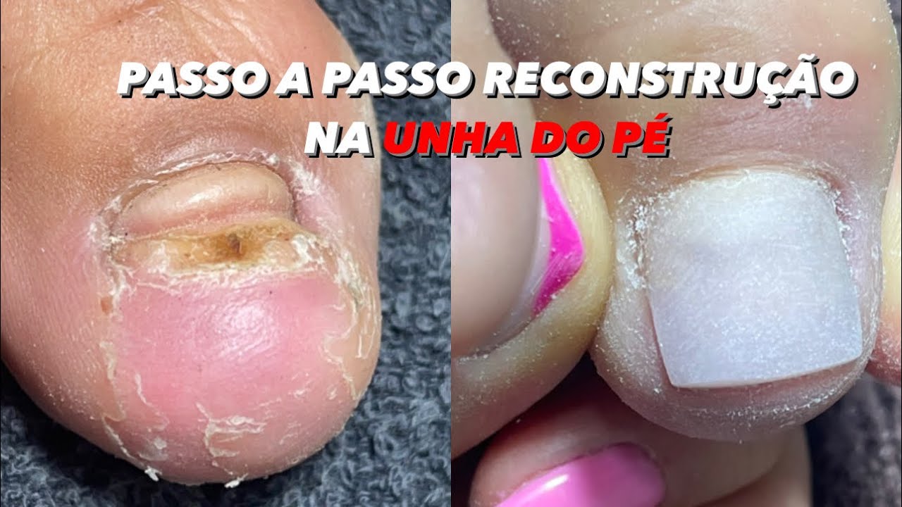 RECONSTRUÇÃO UNHA DOS PÉS!