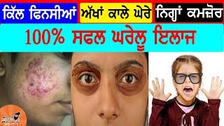Remove Pimples (Acne) | Eyes Dark Circles Naturally Permanently Home Remedy| Cure Weak Eyesight Fast
