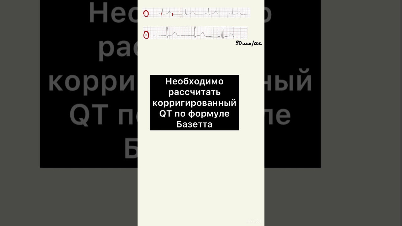 Интервал QT на ЭКГ. Анализ ЭКГ. #Shorts
