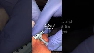 Download lagu How Dermatologists remove moles with before and after #shorts mp3 Download lagu How Dermatologists remove moles with before and after #shorts mp3