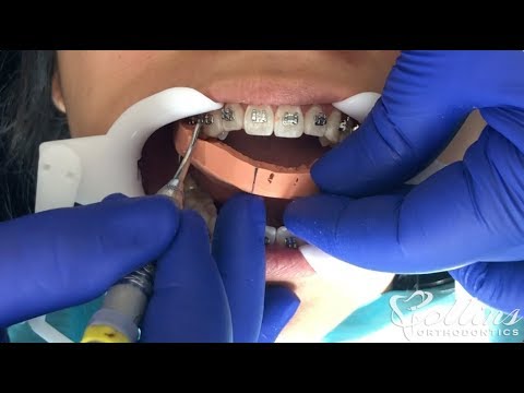 How Braces are Put On Teeth - New Faster Technique (Indirect Bonding)