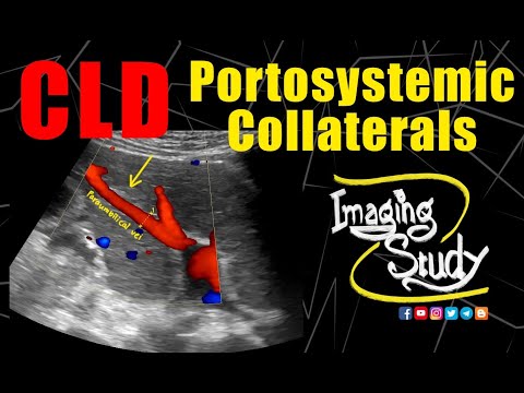 Portosystemic Collaterals In CLD With HCC & PV Thrombosis || Ultrasound || Doppler || Case 176