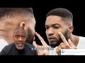 Seborrheic Dermatitis Vs Dandruff In Black Skin Black Dermatologist Explains