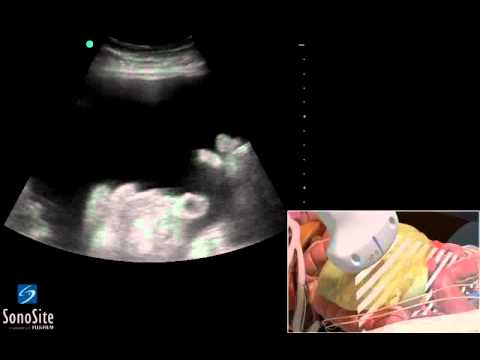 Lombo danneggia fortemente il bacino che è Crema del dolore alle articolazioni delle gambe negli anziani
