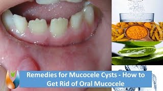 Remedies for Mucocele Cysts - How to Get Rid of Oral Mucocele?