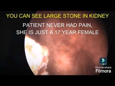 PCNL Surgery | Percutaneous Nephrolithotomy for Kidney Stones| Dr. SK. Palash