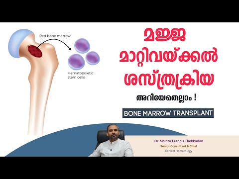Bone Marrow Transplant Surgery || Bone Marrow Transplant || Dr. Shinto Francis Thekkudan