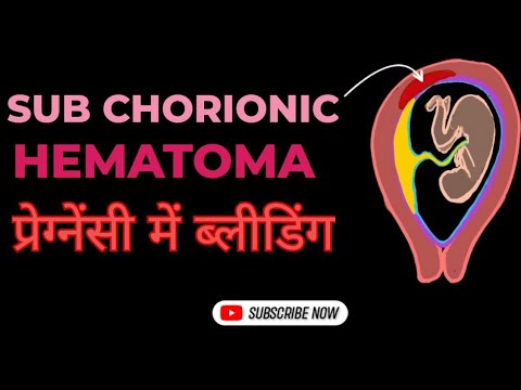 प्रेग्नेंसी में सबकोरियोनिक ब्लीडिंग- क्या है और कैसे ठीक करें | Subchorionic Hematoma in pregnancy