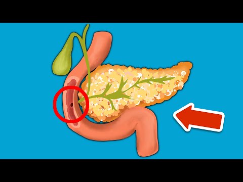 Ignoriere NIEMALS diese Warnzeichen einer Bauchspeicheldrüsenentzündung 💥 (UNBEDINGT beachten) 🤯
