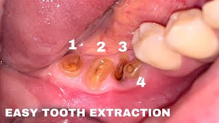 Very Satisfying Tooth Extraction Dokter Gigi Tri Putra Mp4 3GP & Mp3