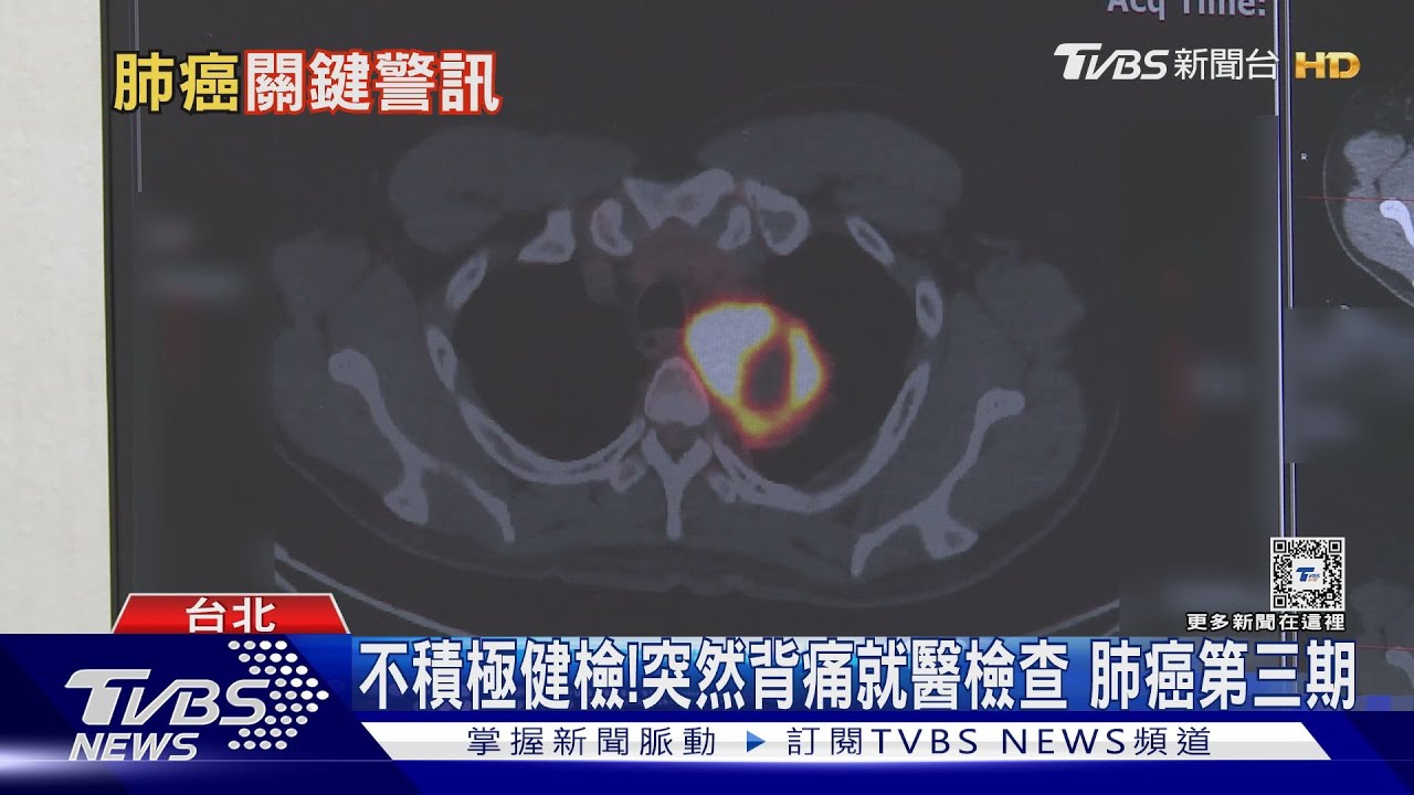 罹患「這個癌」年輕化關鍵因素是「它」!醫師:過半發現已晚期