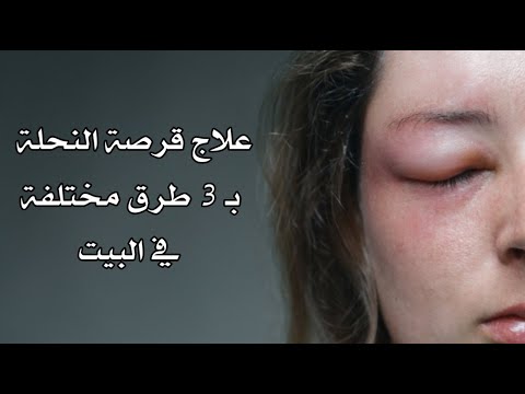 علاج قرصة النحلة بـ 3 طرق مختلفة في البيت