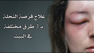 علاج قرصة النحلة بـ 3 طرق مختلفة في البيت علاج قرصة النحلة بـ 3 طرق مختلفة في البيت