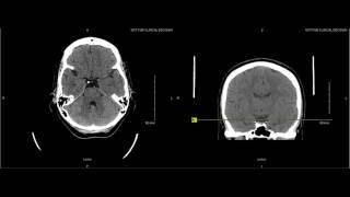 Unremarkable Non-Contrast CT Axial Scan - Example 2
