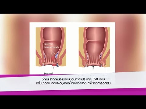 ไม่ว่าจะเป็นไปได้ที่จะเพิ่มขึ้นในระยะเส้นผ่าศูนย์กลาง ผู้หญิงปลุกระดมผ่าน Cooney