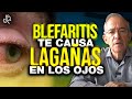 BLEFARITIS Te Causa Lagañas En Los Ojos - Oswaldo Restrepo RSC