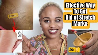 Effective Ways/Remedy to Get Rid of Stretch Marks 2023