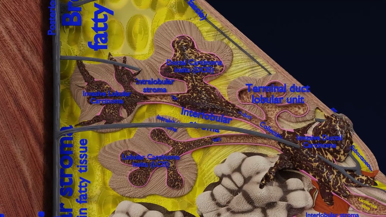 Breast Cancer types spread labelled detail 3D Model
