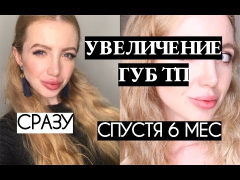 УВЕЛИЧЕНИЕ ГУБ В ТЕХНИКЕ ТП: ВСЕ ПРОПАЛО, МОЕ МНЕНИЕ СПУСТЯ 6 МЕС