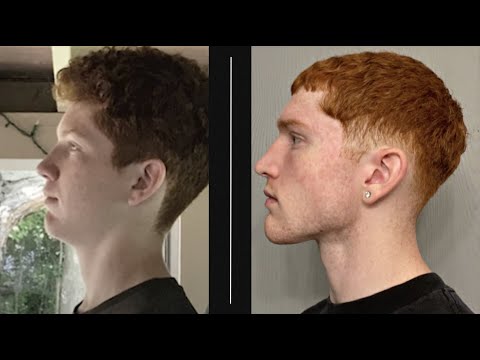 How I Improved My Face and Jawline (Look Better Now!)