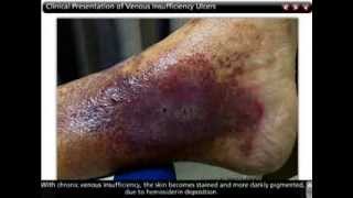 Venous Leg Ulcers | Common Wound Types | WoundEducators