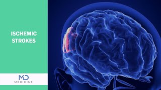 Understanding Ischemic Strokes: Recognizing Signs, Reducing Risks, and Recovering Strong