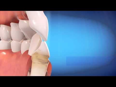 download lagu mp3 mp4 Invisalign North Vancouver Bc, download lagu Invisalign North Vancouver Bc gratis, unduh video klip Invisalign North Vancouver Bc