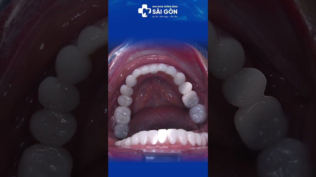 Case Dán Sứ Veneers 20 Răng | Nha Khoa Trồng Răng Sài Gòn #veneers